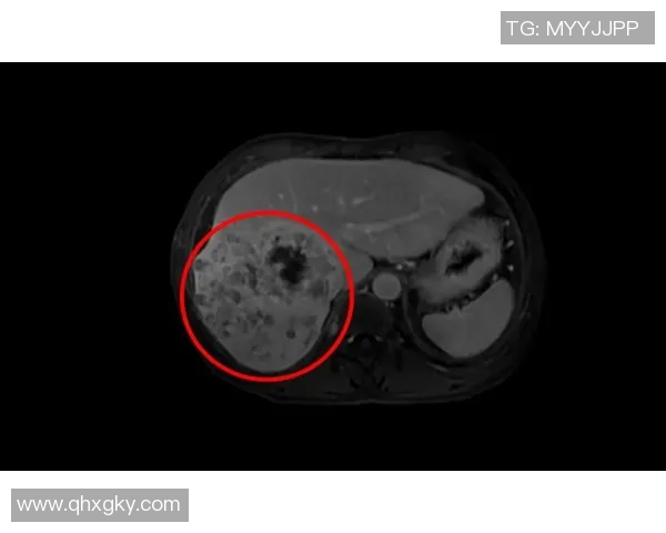 肝癌夺走足球明星生命的悲剧与启示